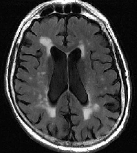 'White matter lesion' mapping tool identifies early signs of dementia