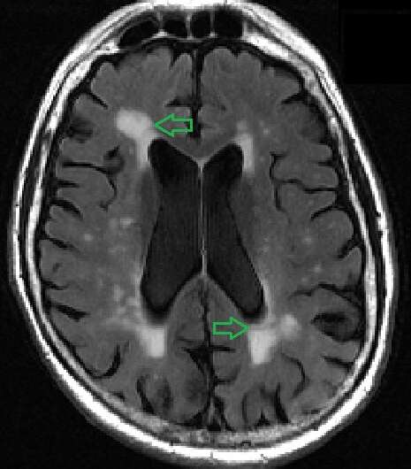 'White matter lesion' mapping tool identifies early signs of dementia