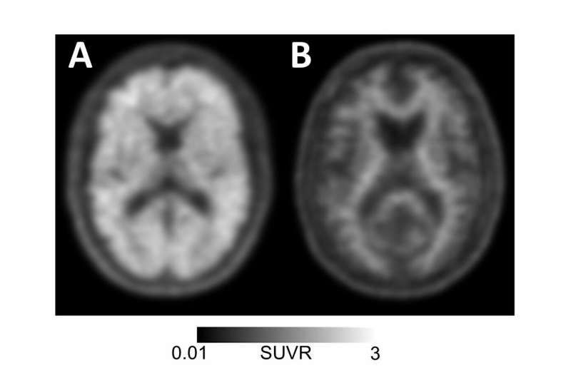 Alzheimer's diagnosis, management improved by brain scans 