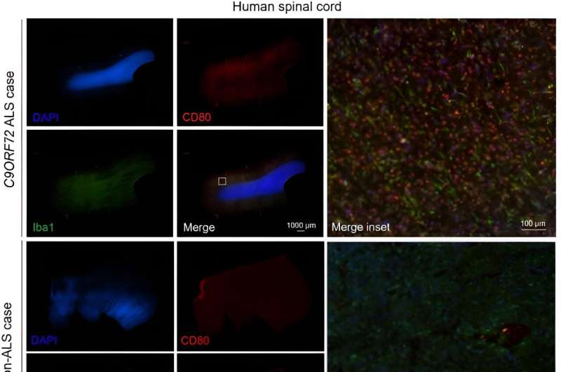 New study identifies gene believed to be responsible for ALS and dementia