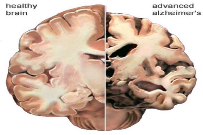 What really causes Alzheimer's and how might we fix it? 