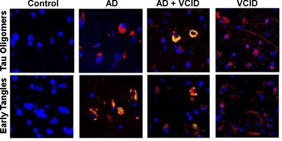 Forget me not: Novel target shows promise in treating Alzheimer's and related dementias