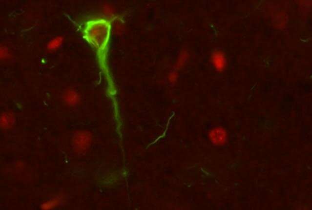 Overlooked tau-RNA interaction plays key role in dementia