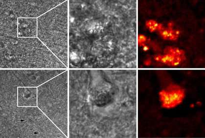 Imaging technique shows progress Alzheimer's disease