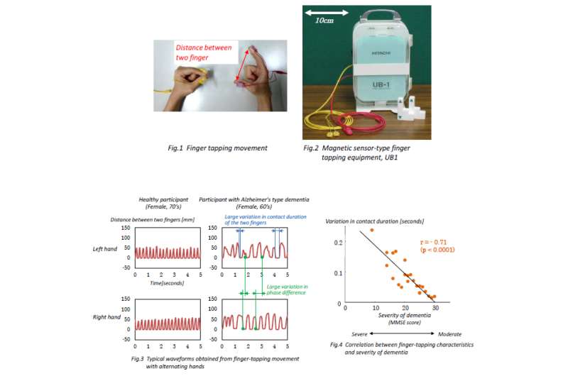 Successful extraction of Alzheimer's-type dementia finger-tapping pattern