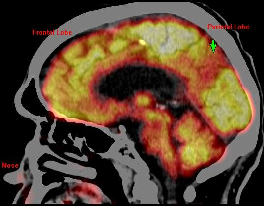 From Alzheimer’s to autism, nuclear neurology could launch revolution in diagnosing and treating brain diseases