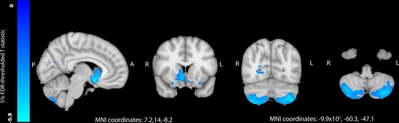 Gout strongly associated with reduced gray matter and increased neurodegenerative disease