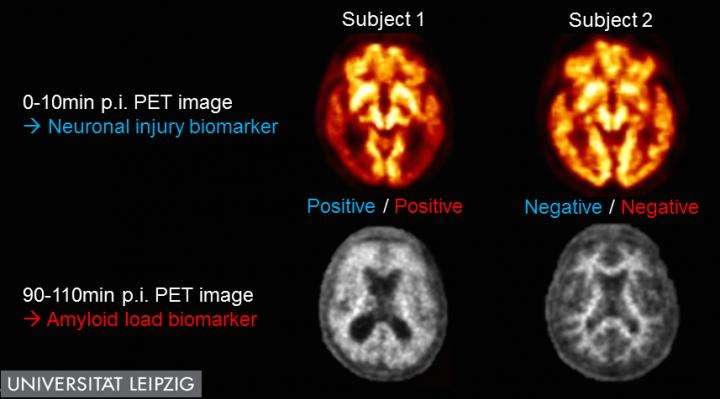 Single dual time-point PET scan identifies dual Alzheimer's biomarkers 