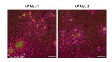 Alzheimer's disease could be treated with gene therapy, suggests animal study