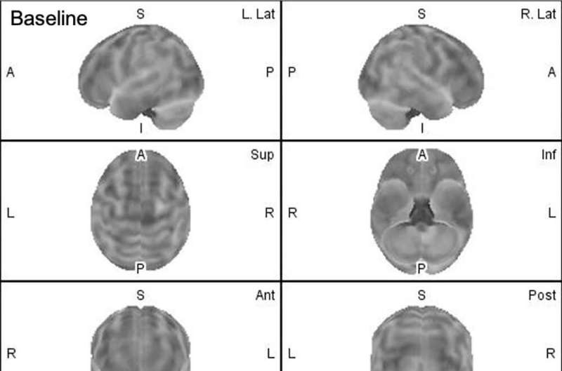 Recurrent brain trauma may increase Alzheimer's risk