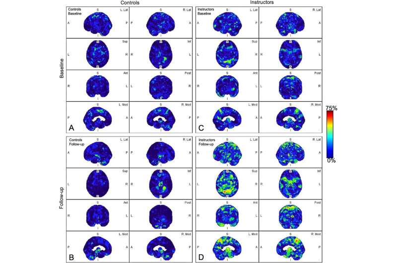 Recurrent brain trauma may increase Alzheimer's risk 