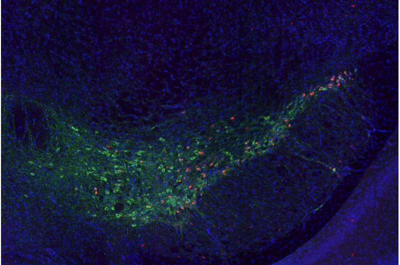 Gene ID'd as potential therapeutic target for dementia in Parkinson's 