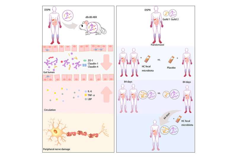 Fecal transplants correlated to distal symmetric polyneuropathy symptoms