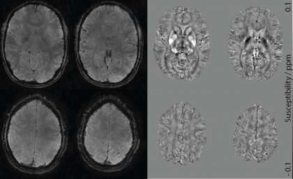 Accelerated MRI brain mapping technique to improve neurodegenerative diagnosis