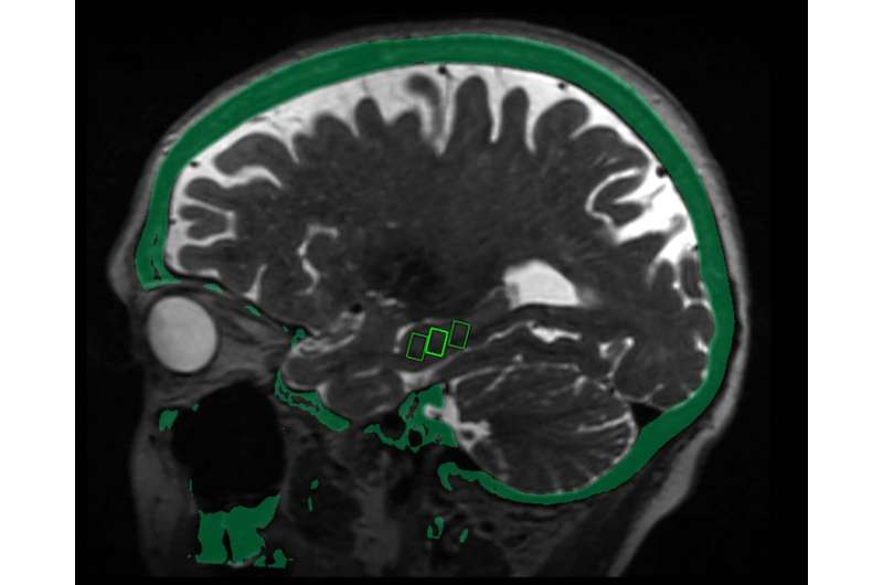 Focused ultrasound may open door to Alzheimer's treatment 