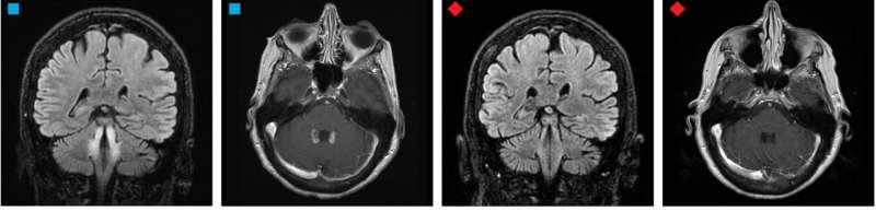 Form of B12 deficiency in cerebral spinal fluid found to negatively affect the central nervous system