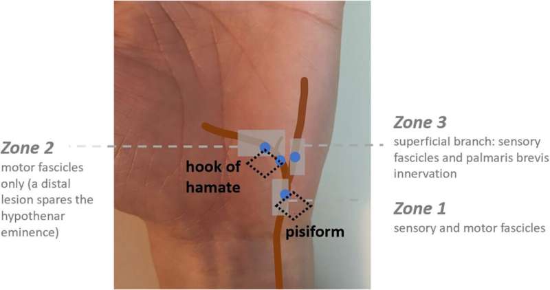 Work-related nerve injuries are common with repetitive motions