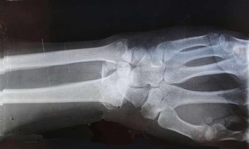  bone xray