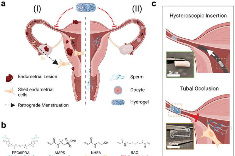 Researchers develop hydrogel implant to treat endometriosis