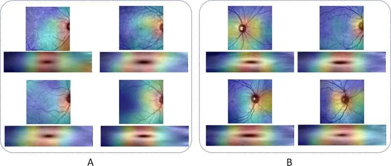 New Durham University study shows promising diagnosis of Multiple Sclerosis from images of the eye