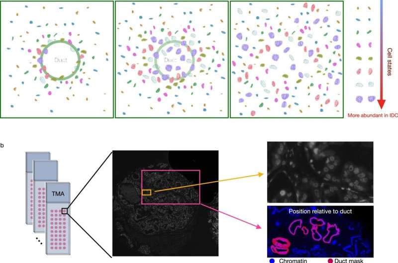 AI model identifies certain breast tumor stages likely to progress to invasive cancer