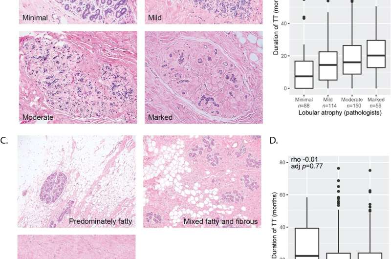 Testosterone therapy may protect against breast cancer in trans masculine individuals