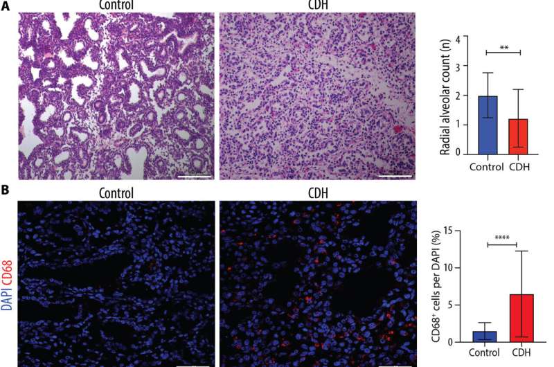 New research into life-threatening birth defect of the diaphragm