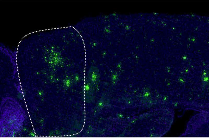 Dopamine treatment found to alleviate symptoms in Alzheimer's disease