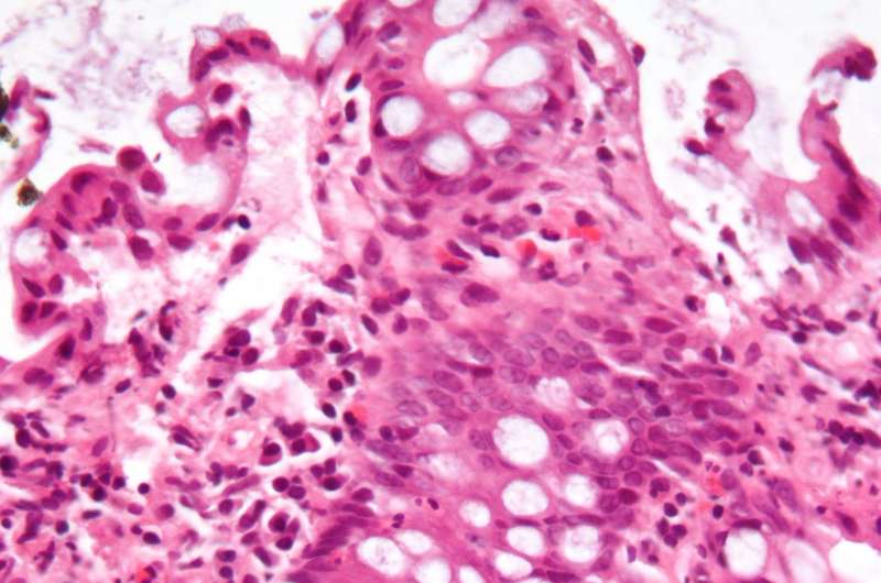 Study identifies a new disease-inducing mechanism for inflammatory bowel disease