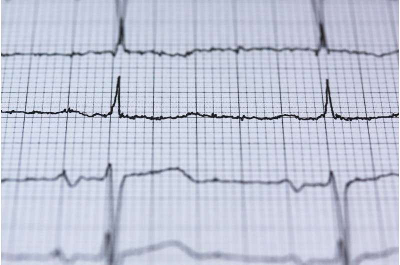 electrocardiogram