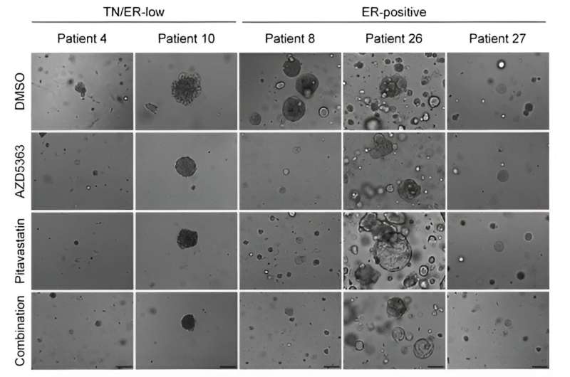 Combining cholesterol-lowering statins with existing cancer drug shows potent effect against breast cancer subtype