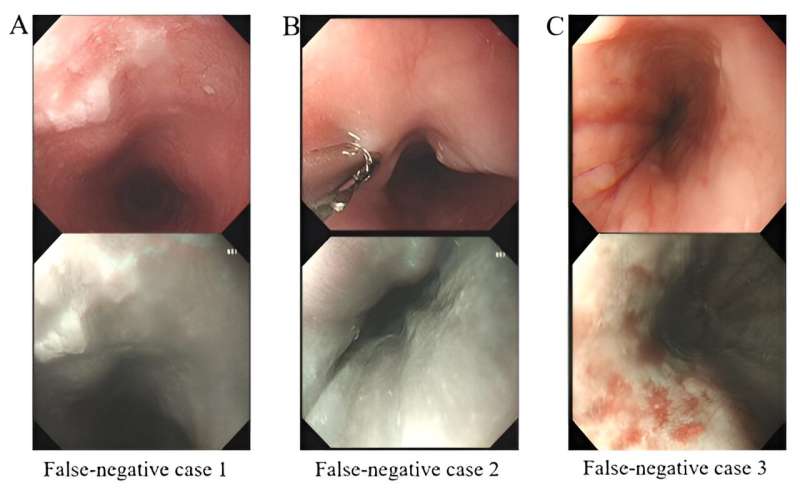 Experimental AI method boosts doctors' ability to diagnose cancers and precancers of the esophagus