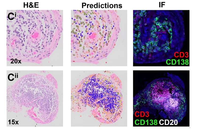 Machine learning helps identify rheumatoid arthritis subtypes