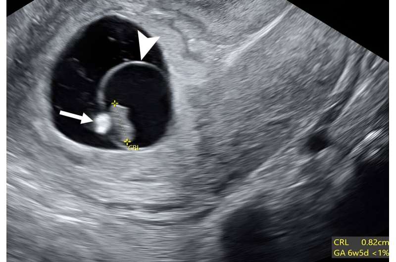 Expert panel endorses new ultrasound terminology for early pregnancy