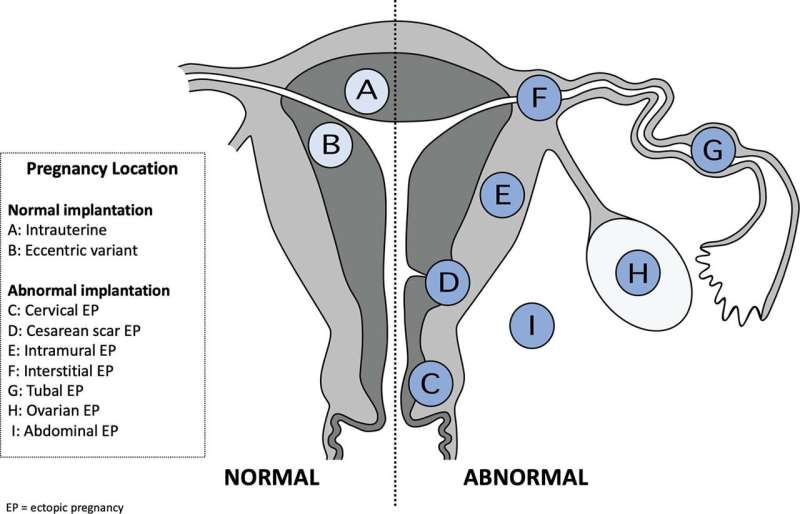 Expert panel endorses new ultrasound terminology for early pregnancy