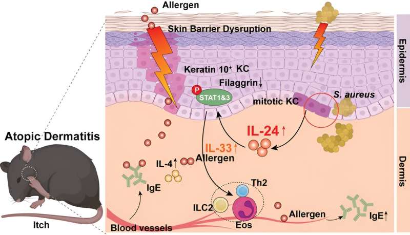 Study establishes IL-24 as a critical factor for onset and progression of atopic dermatitis