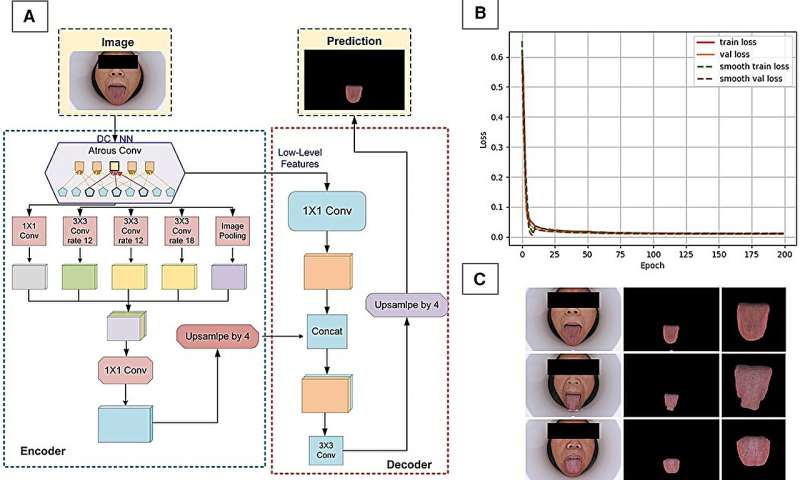 AI-based tongue imaging could help enable non-invasive detection of coronary artery disease