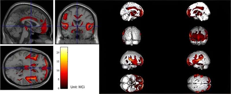 A breakthrough in diagnosing hydrocephalus: Multimodality approaches enhance accuracy and reduce costs