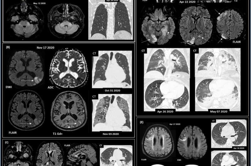 Inflammation may link COVID-19 severity to the onset of neurological symptoms