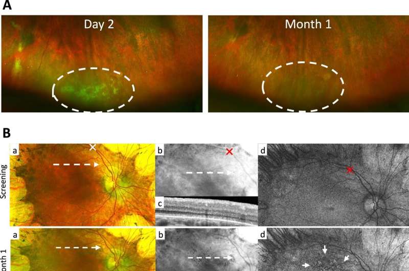 Gene therapy found to be effective in hereditary blindness