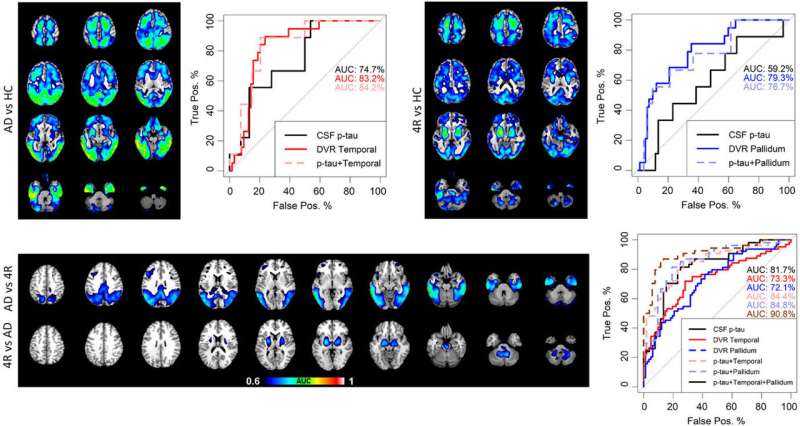 A new biomarker makes it easier to distinguish between Alzheimer's and primary tauopathy