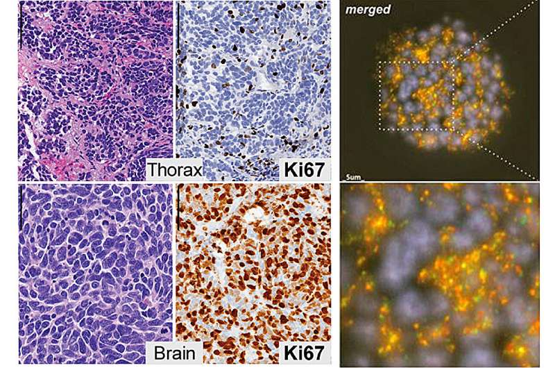 New, rare type of small cell lung cancer identified