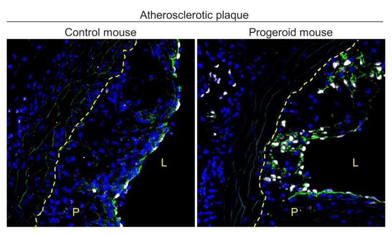 A new mechanism of early-onset atherosclerosis in a premature aging syndrome