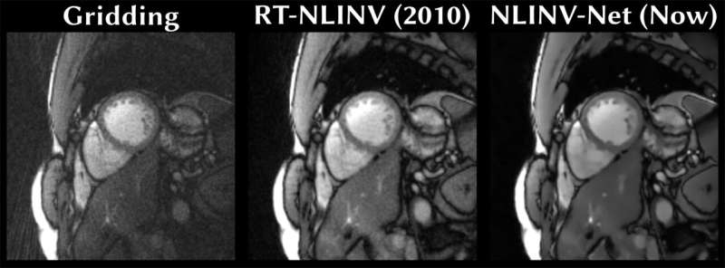 Better MRI videos thanks to new machine learning method