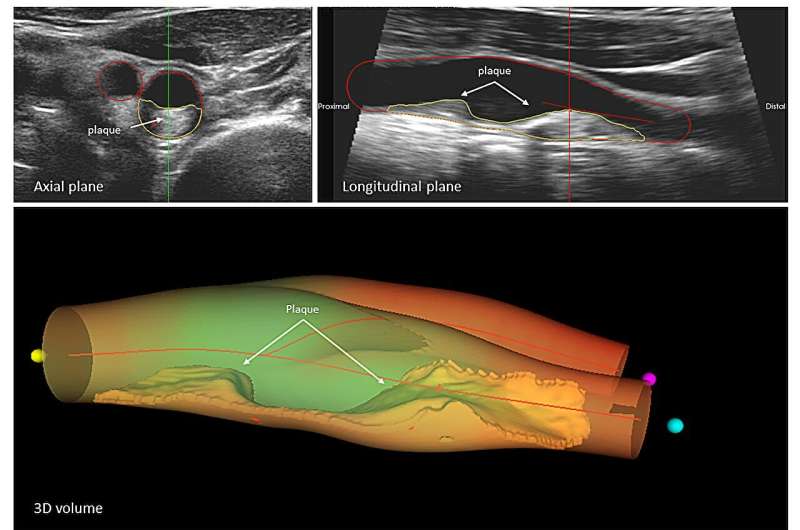 Study demonstrates progression of subclinical atherosclerosis predicts all-cause mortality risk