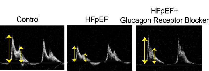 Study proposes new heart failure treatment targeting abnormal hormone activity