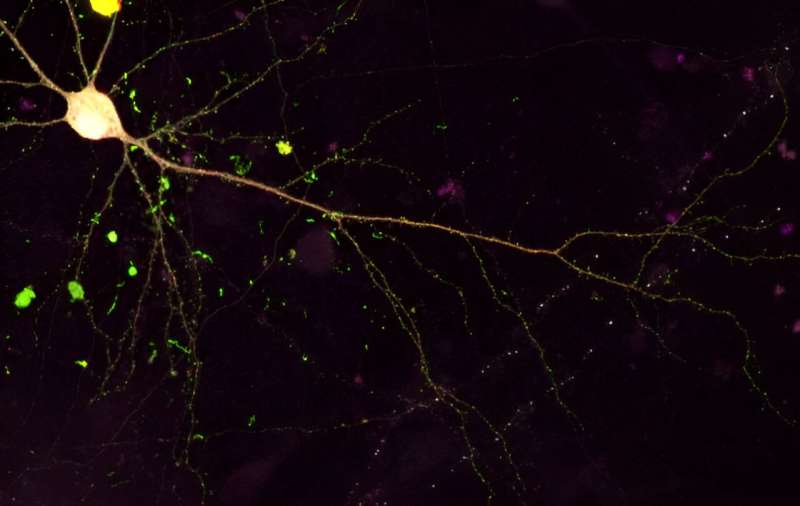 Researchers develop way to selectively target diseased cells in motor neurone disease