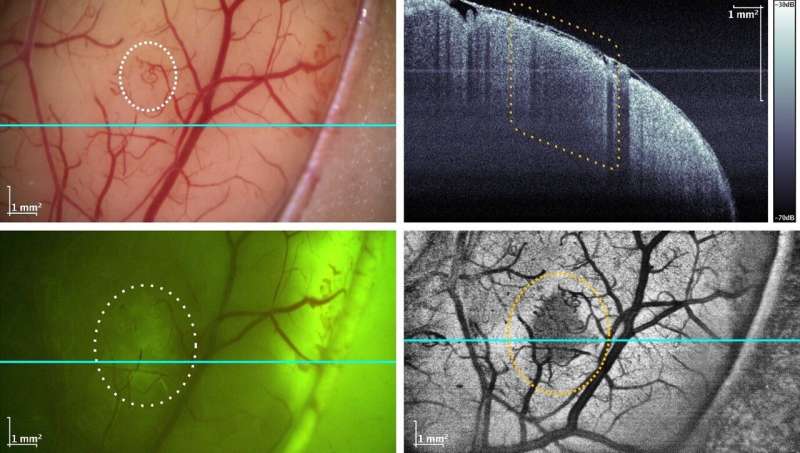 Researchers integrate fast optical coherence tomography system into neurosurgical microscope