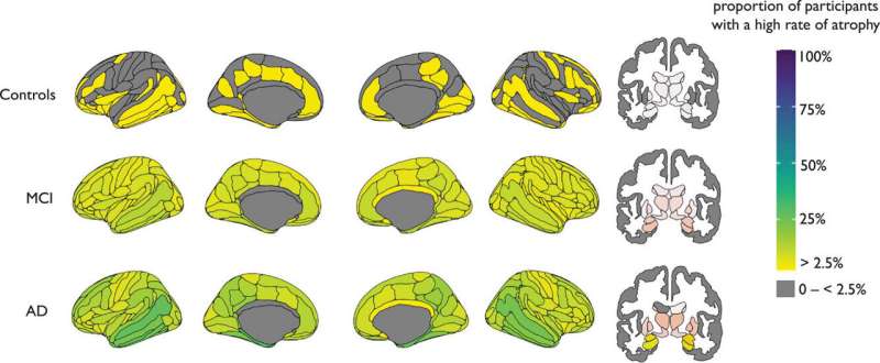 Study finds no uniform brain shrinkage pattern in Alzheimer's