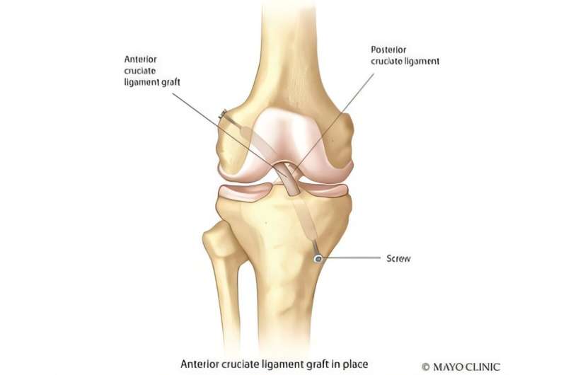 Feel a pop, then pain in your knee? It could be an ACL tear